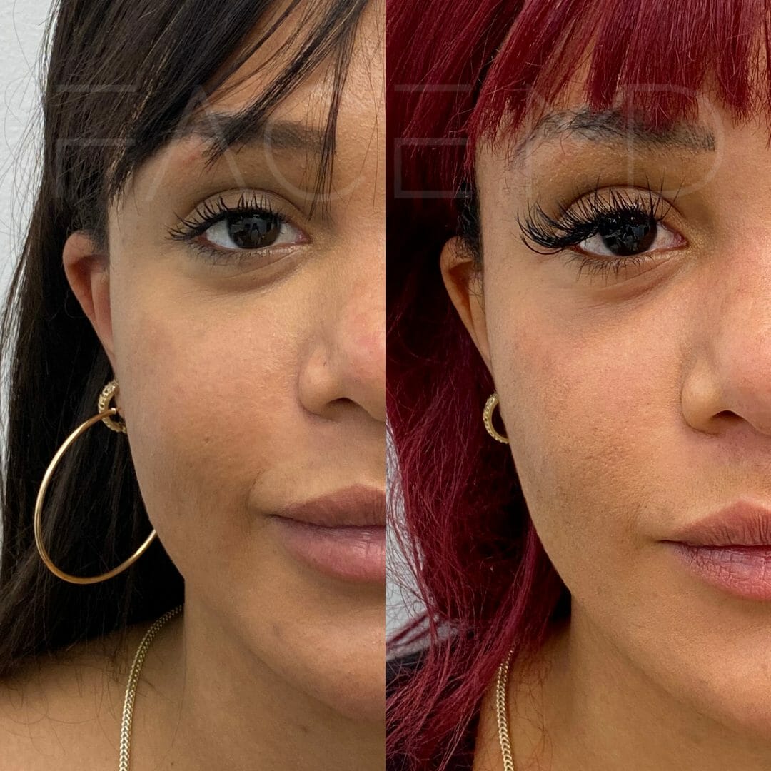 Buccal fat removal Montreal  FACE MD - Plastic Surgery - Buccal fat  reduction - Buccal fat pad removal - Buccal fat surgery - Define your  cheekbones with a buccal fat pad treatment