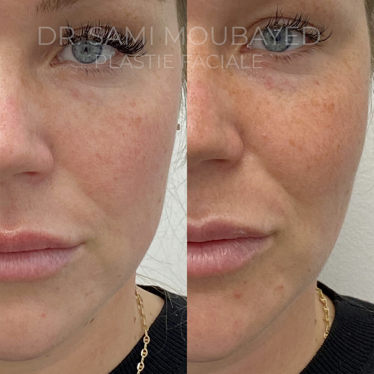 Buccal fat removal Montreal  FACE MD - Plastic Surgery - Buccal fat  reduction - Buccal fat pad removal - Buccal fat surgery - Define your  cheekbones with a buccal fat pad treatment