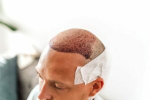 How Much Is A Hair Transplant In Montreal 768x512 1