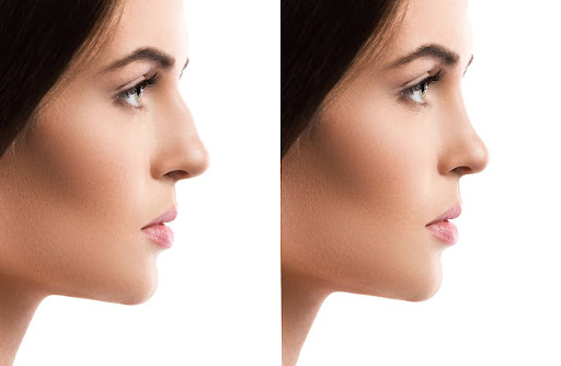 How to reduce swelling after rhinoplasty cast removal