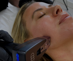 How does co2 laser resurfacing work