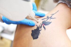 How much does it cost for laser tattoo removal