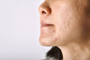 How to get rid of acne scars laser treatment