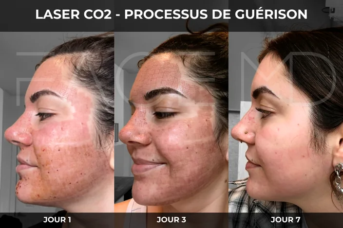 Guérison Laser CO2