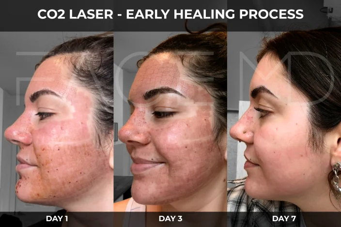 CO2 Laser Recovery