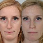 Source: Dr. Moubayed’s practice. Not a guarantee of results. Photos published with informed written consent of patients Female treated with ultrasonic rhinoplasty