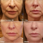 Source: Dr. Moubayed’s practice. Not a guarantee of results. Photos published with informed written consent of patients Female treated with Silhouette Instalift thread lift