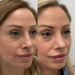 Source: Dr. Moubayed’s practice. Not a guarantee of results. Photos published with informed written consent of patients Female treated with revision rhinoplasty