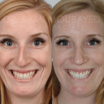 Source: Dr. Moubayed’s practice. Not a guarantee of results. Photos published with informed written consent of patients Female treated with ultrasonic rhinoplasty