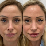 Source: Dr. Moubayed’s practice. Not a guarantee of results. Photos published with informed written consent of patients Female treated with revision rhinoplasty