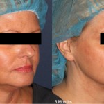 Source: Dr. Moubayed’s practice. Not a guarantee of results. Photos published with informed written consent of patients Female treated with Silhouette Instalift thread lift
