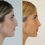 Source: Dr. Moubayed’s practice. Not a guarantee of results. Photos published with informed written consent of patients Female treated with ultrasonic rhinoplasty