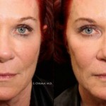 Source: Dr. Moubayed’s practice. Not a guarantee of results. Photos published with informed written consent of patients Female treated with Silhouette Instalift thread lift now available in Montreal