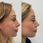 Source: Dr. Moubayed’s practice. Not a guarantee of results. Photos published with informed written consent of patients Female treated with revision rhinoplasty