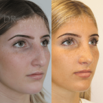 Source: Dr. Moubayed’s practice. Not a guarantee of results. Photos published with informed written consent of patients Female treated with ultrasonic rhinoplasty