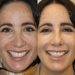Source: Dr. Moubayed’s practice. Not a guarantee of results. Photos published with informed written consent of patients Female treated with revision rhinoplasty