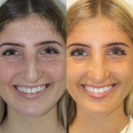 Source: Dr. Moubayed’s practice. Not a guarantee of results. Photos published with informed written consent of patients Female treated with ultrasonic rhinoplasty