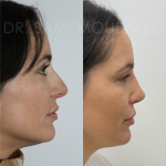 Source: Dr. Moubayed’s practice. Not a guarantee of results. Photos published with informed written consent of patients Female treated with revision rhinoplasty