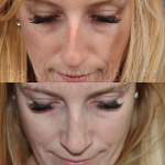 Source: Dr. Moubayed’s practice. Not a guarantee of results. Photos published with informed written consent of patients Female treated with ultrasonic rhinoplasty