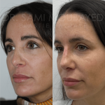 Source: Dr. Moubayed’s practice. Not a guarantee of results. Photos published with informed written consent of patients Female treated with revision rhinoplasty