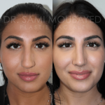Source: Dr. Moubayed’s practice. Not a guarantee of results. Photos published with informed written consent of patients Female treated with ultrasonic rhinoplasty