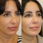 Source: Dr. Moubayed’s practice. Not a guarantee of results. Photos published with informed written consent of patients Female treated with revision rhinoplasty