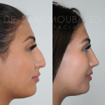 Source: Dr. Moubayed’s practice. Not a guarantee of results. Photos published with informed written consent of patients Female treated with ultrasonic rhinoplasty