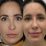 Source: Dr. Moubayed’s practice. Not a guarantee of results. Photos published with informed written consent of patients Female treated with revision rhinoplasty