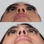 Source: Dr. Moubayed’s practice. Not a guarantee of results. Photos published with informed written consent of patients Female treated with ultrasonic rhinoplasty