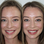 Source: Dr. Moubayed’s practice. Not a guarantee of results. Photos published with informed written consent of patients Female treated with ultrasonic rhinoplasty