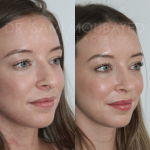 Source: Dr. Moubayed’s practice. Not a guarantee of results. Photos published with informed written consent of patients Female treated with ultrasonic rhinoplasty