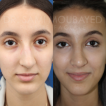 Source: Dr. Moubayed’s practice. Not a guarantee of results. Photos published with informed written consent of patients