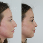 Source: Dr. Moubayed’s practice. Not a guarantee of results. Photos published with informed written consent of patients Female treated with ultrasonic rhinoplasty