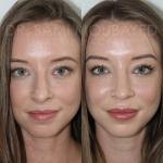 Source: Dr. Moubayed’s practice. Not a guarantee of results. Photos published with informed written consent of patients Female treated with ultrasonic rhinoplasty