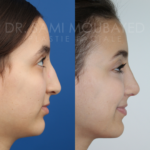 Source: Dr. Moubayed’s practice. Not a guarantee of results. Photos published with informed written consent of patients