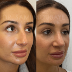 Source: Dr. Moubayed’s practice. Not a guarantee of results. Photos published with informed written consent of patients Female treated with ultrasonic rhinoplasty