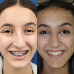 Source: Dr. Moubayed’s practice. Not a guarantee of results. Photos published with informed written consent of patients Middle Eastern female treated with septorhinoplasty