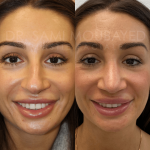 Source: Dr. Moubayed’s practice. Not a guarantee of results. Photos published with informed written consent of patients Female treated with ultrasonic rhinoplasty