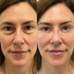 Lower blepharoplasty on this woman, still healing but already so beautiful!