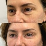 Lower blepharoplasty on this woman, still healing but already so beautiful!
