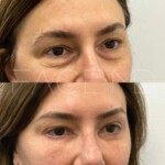 Lower blepharoplasty on this woman, still healing but already so beautiful!