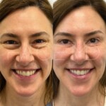 Lower blepharoplasty on this woman, still healing but already so beautiful!