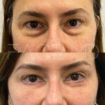 Lower blepharoplasty on this woman, still healing but already so beautiful!