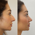 Source: Dr. Moubayed’s practice. Not a guarantee of results. Photos published with informed written consent of patients Female treated with ultrasonic rhinoplasty