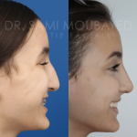 Source: Dr. Moubayed’s practice. Not a guarantee of results. Photos published with informed written consent of patients Middle Eastern female treated with septorhinoplasty