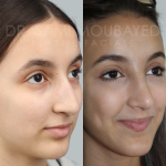 Source: Dr. Moubayed’s practice. Not a guarantee of results. Photos published with informed written consent of patients Middle Eastern female treated with septorhinoplasty