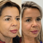 Source: Dr. Moubayed’s practice. Not a guarantee of results. Photos published with informed written consent of patients Female treated with ultrasonic rhinoplasty