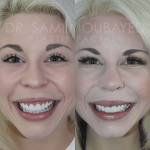 Source: Dr. Moubayed’s practice. Not a guarantee of results. Photos published with informed written consent of patients Female treated with rhinoplasty and alar base reductions