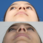 Source: Dr. Moubayed’s practice. Not a guarantee of results. Photos published with informed written consent of patients Middle Eastern female treated with septorhinoplasty