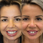 Source: Dr. Moubayed’s practice. Not a guarantee of results. Photos published with informed written consent of patients Female treated with ultrasonic rhinoplasty